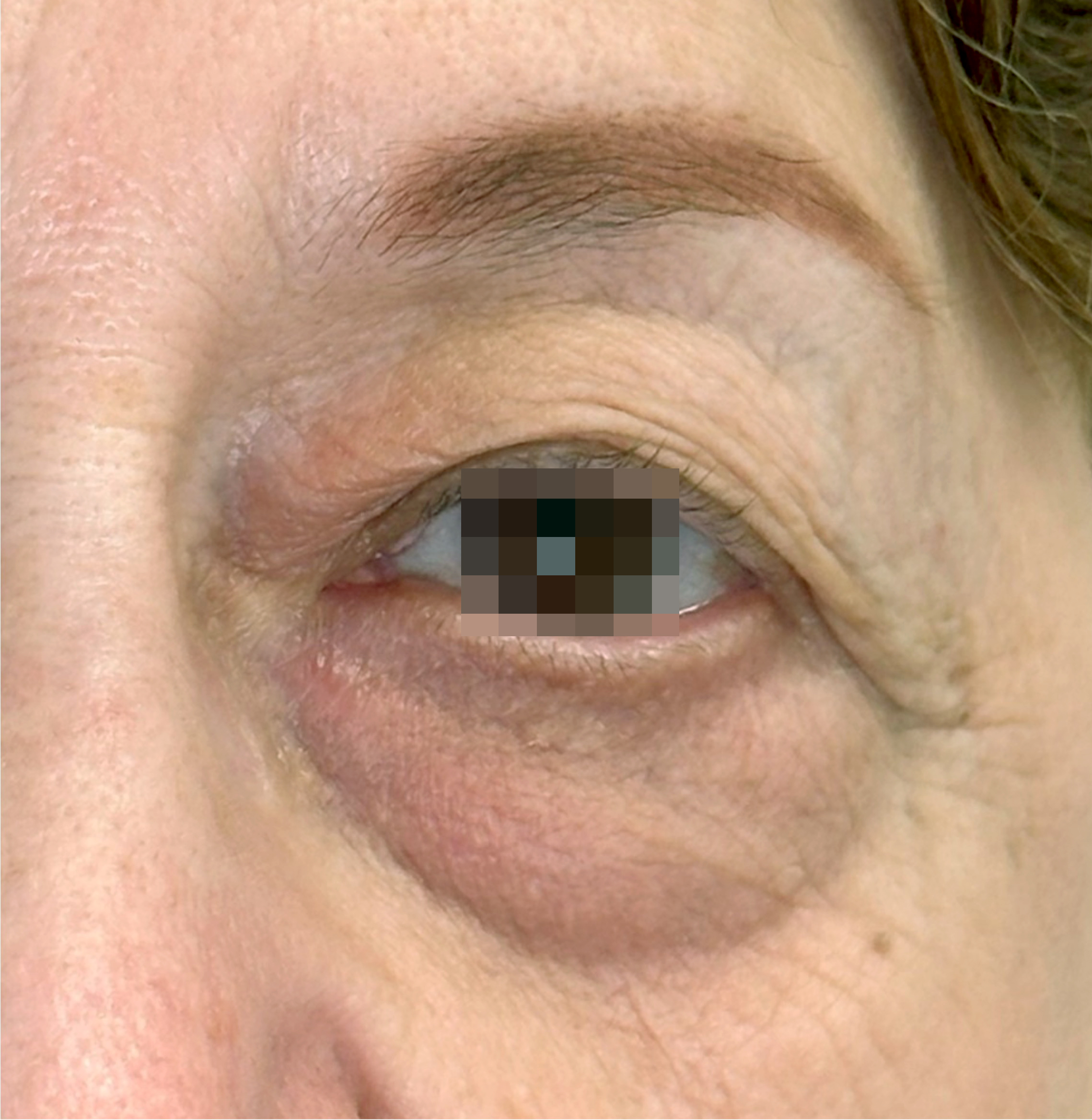 OptiLIFT BEFORE Image