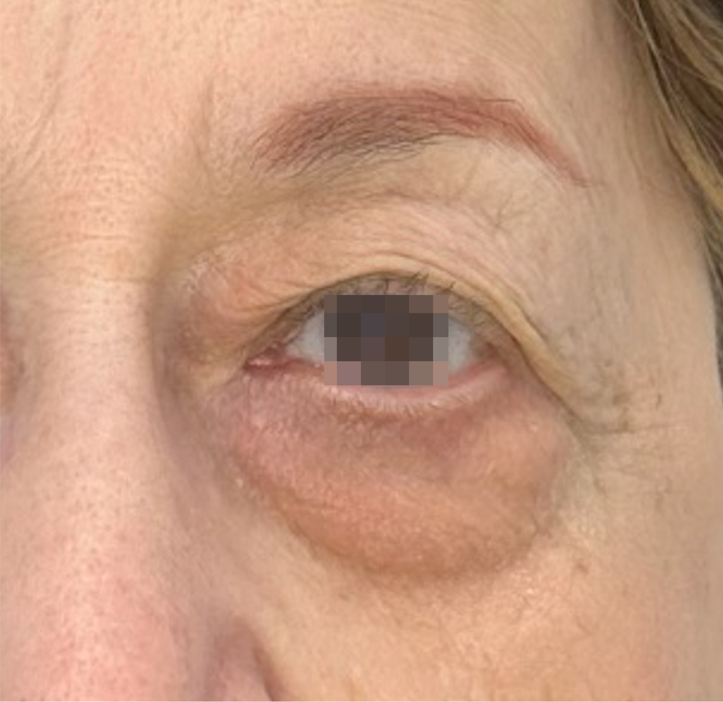 OptiLIFT AFTER Image